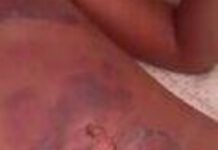 Menino sofre queimaduras graves após ser deixado sozinho e tentar cozinhar