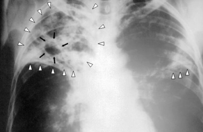 Tuberculosis-x-ray-1